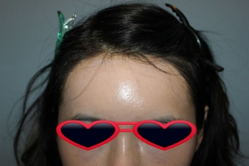 수술 후 11일째 정면