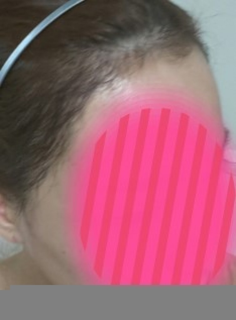 138일째 헤어라인 - 잔머리 송송 나기 시작