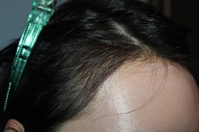 수술 후 11일 째 측면