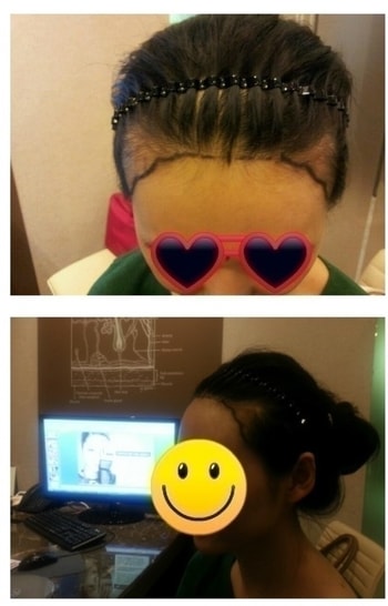 헤어라인 교정 전 디자인