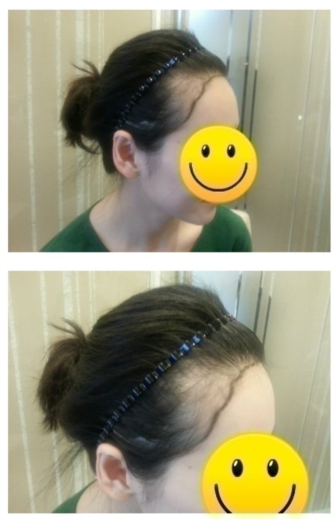 헤어라인 교정 전 디자인