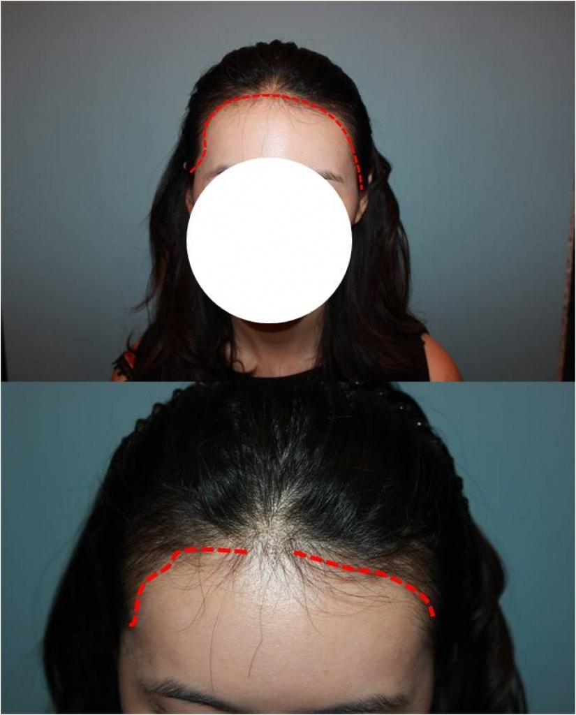 헤어라인교정 수술 후 정면