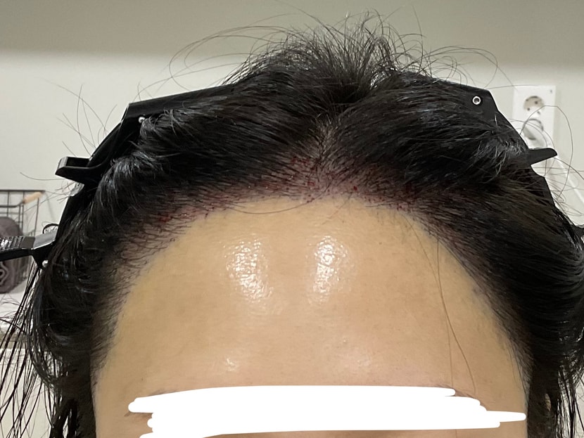 리터치 당일