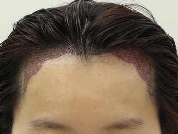 수술 후