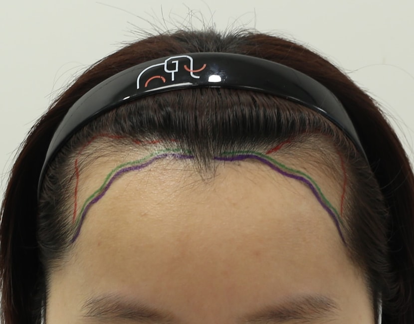 수술 전 디자인