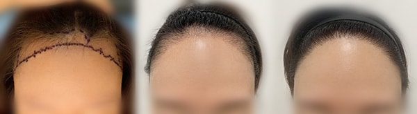 수술직전 사진이랑 암흑기사진 그리고 최근 사진까지 비교해보니 변화가 잘 보이네요