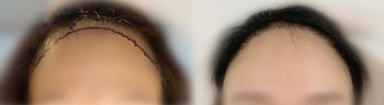 분명 많이 심었는데 여전히 넓은 이마 같아서 시원히 까고 다니지 못하겠어요..
