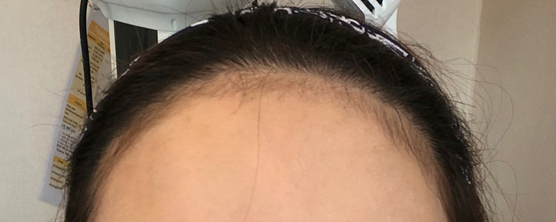 ﻿이틀전 병원에서 찍은 셀카