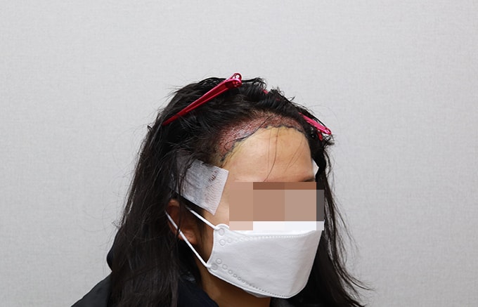 ﻿수술끝나고 찍었어요!