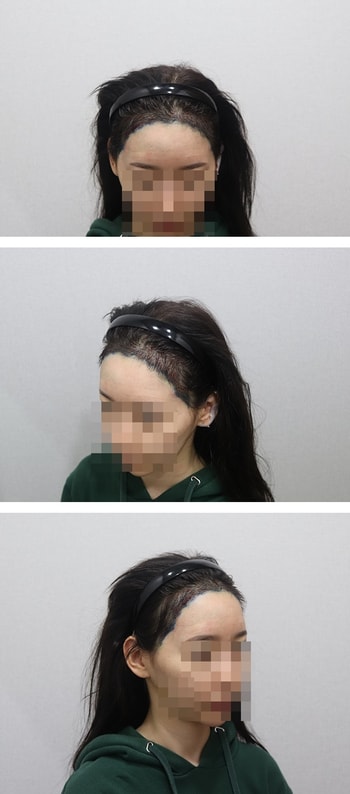 수술 직후 사진