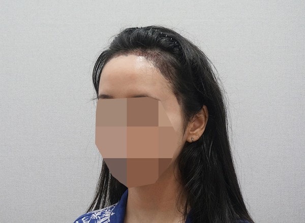 수술 다음날 찍은 사진이에용 