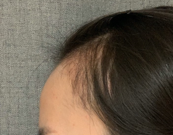 지금 모습이에요.. 다시 이식 전으로 돌아간거 같아요