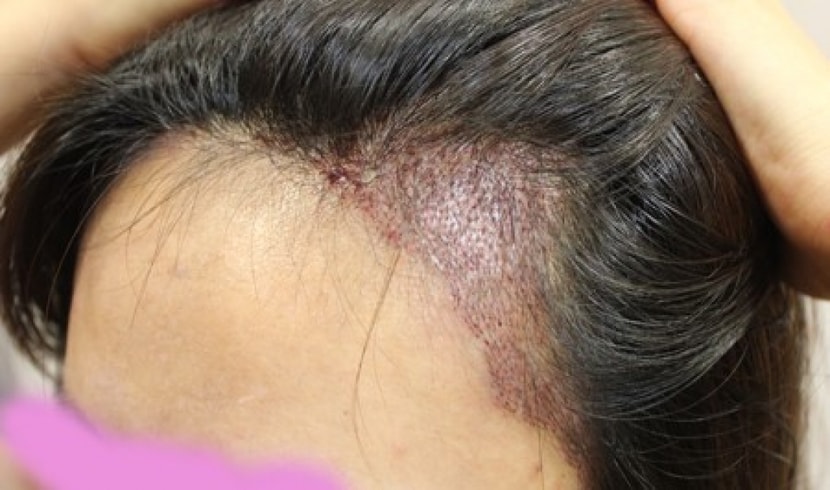 이것도 이식후 다음날~