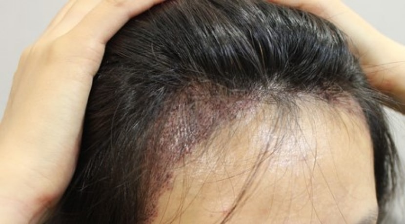 이식후다음날!!