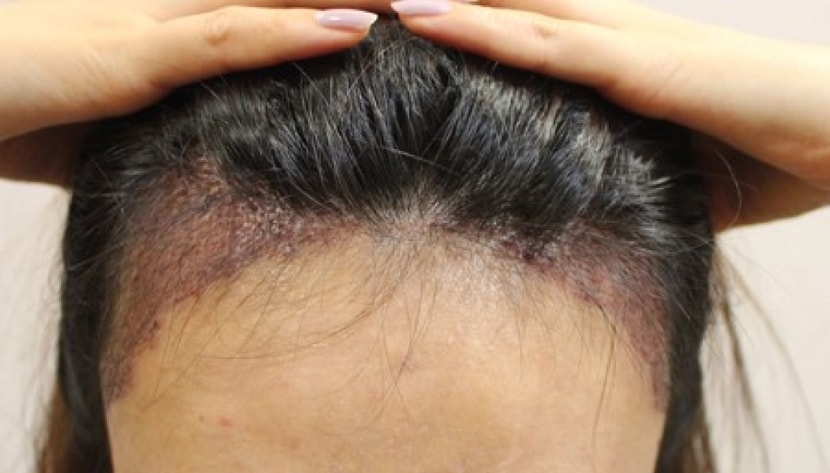 이식후 다음날~