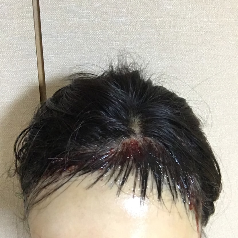 앞(당일)