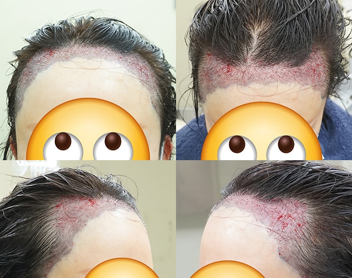 수술직후