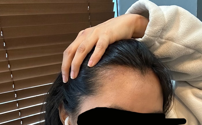 수술 2개월차, 메조 주사맞고