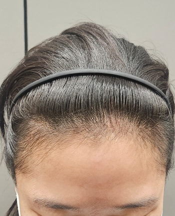 수술한달
