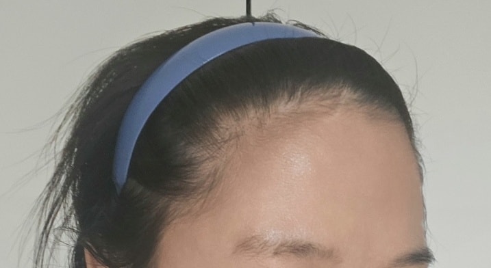 수술전