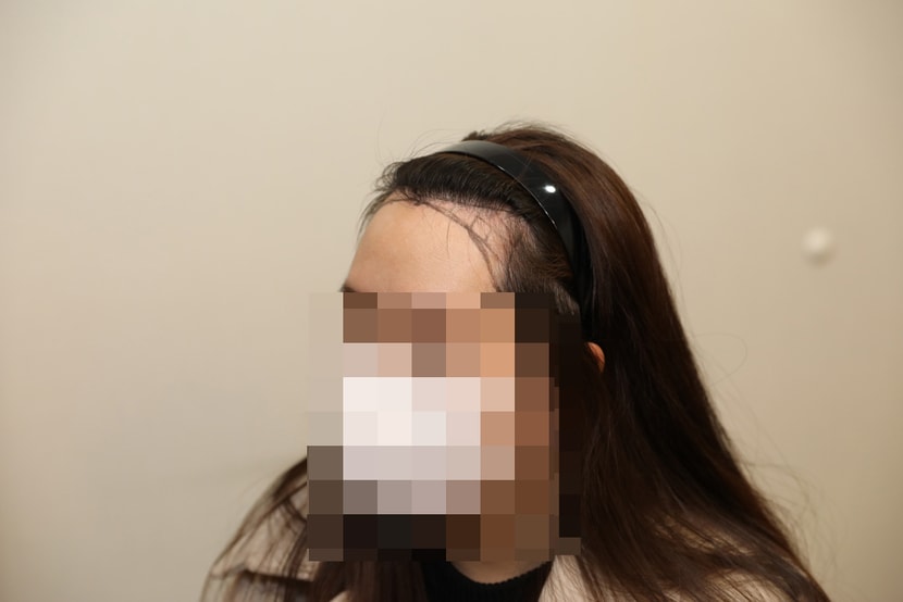 실제로는 이것보다 길이 조금 더 내려서 수술 들어갔습니다 ㅎㅎ