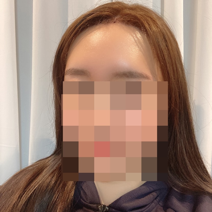 원래 있던 앞머리로 살짝 가린모습 ㅋㅋㅋㅋ 정수리 감각 없어서 어색...