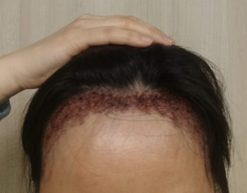 시술 다음날 샴푸와 두피관리를 받은 모습입니다.
