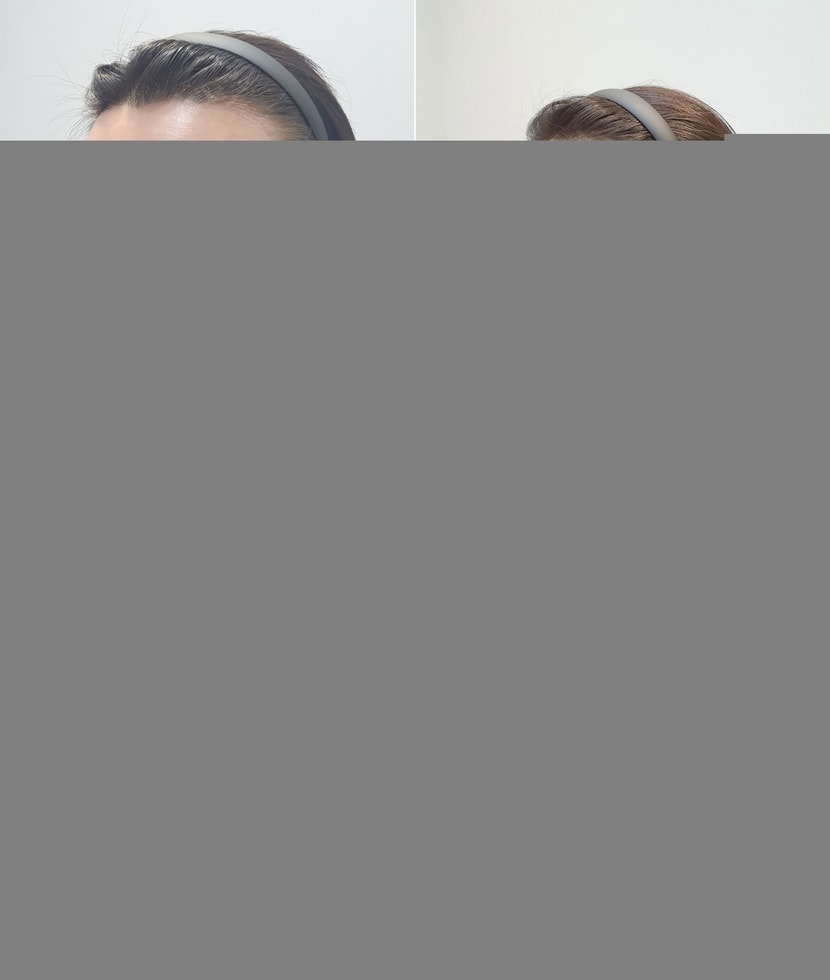 수술하기전 사진과 디자인 한 사진