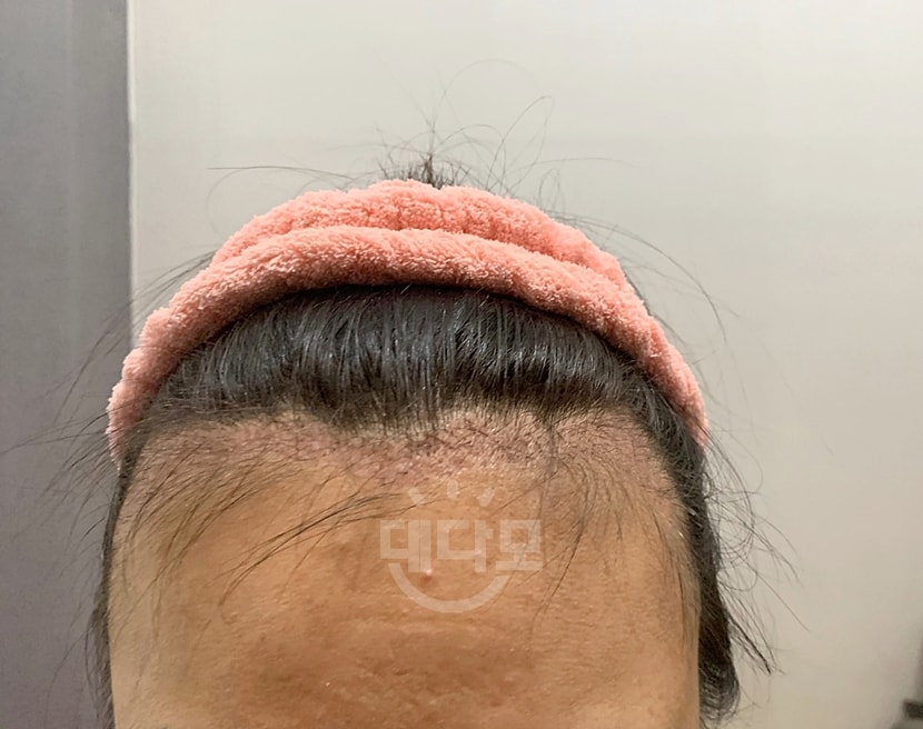 &lt;이식 1달 암흑기&gt;