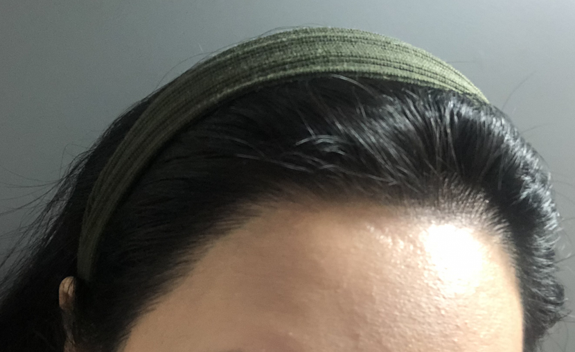 수술 후 (옆라인)