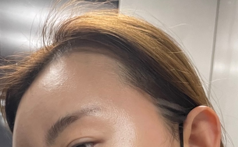 수술전 헤어라인