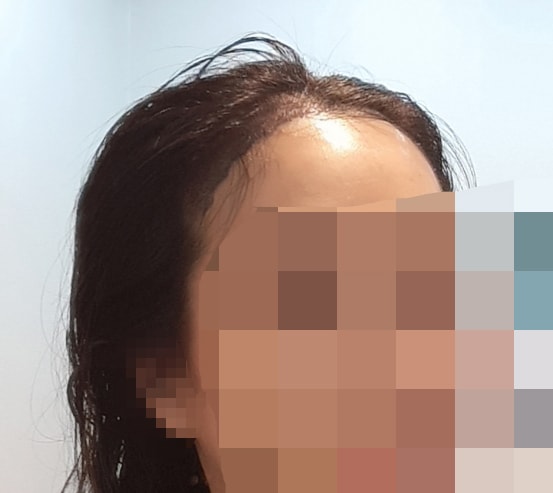 수술 다음 날 샴푸 후