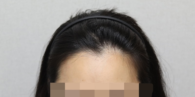 비절개 2500모 저번주에 수술 받았어요~~