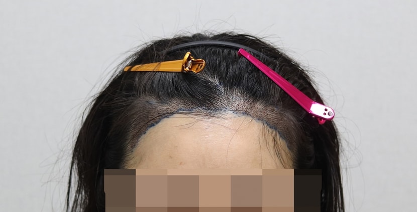 수술 다음 날 샴푸 후