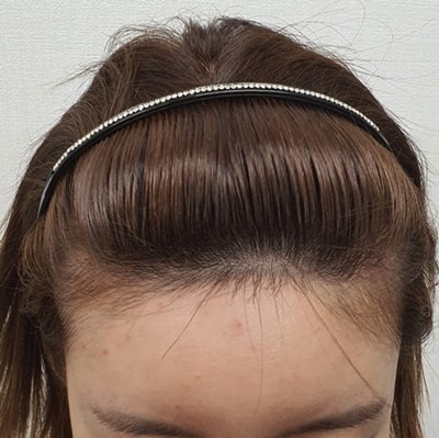 수술전