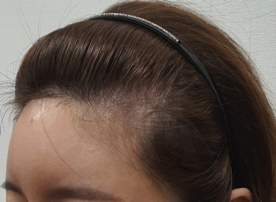 수술전