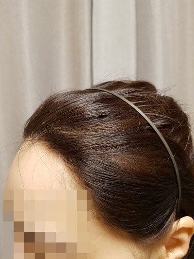 헤어라인교정 1년 현재