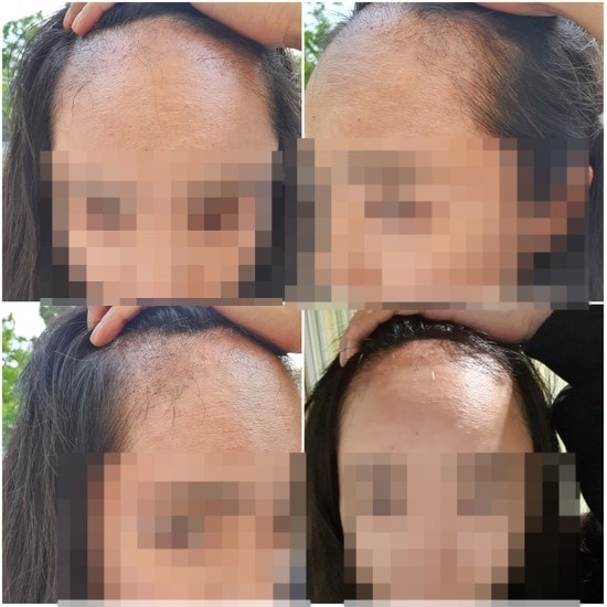 수술 후 2~3개월 암흑기 시절