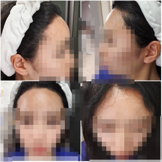 수술 후 8개월 현재