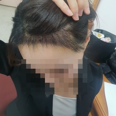 수술 초기