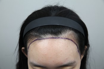 수술 전 디자인