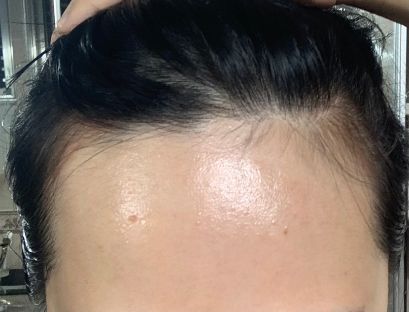 헤어라인 하기전 앞모습입니다