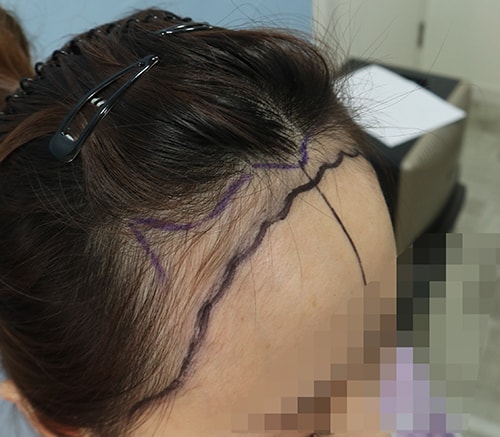 수술전 디자인이요