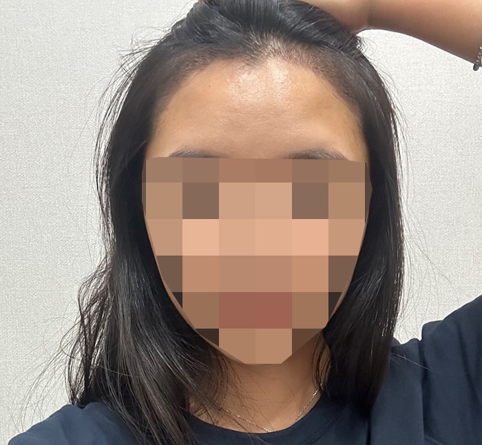 수술 14일차 셀카