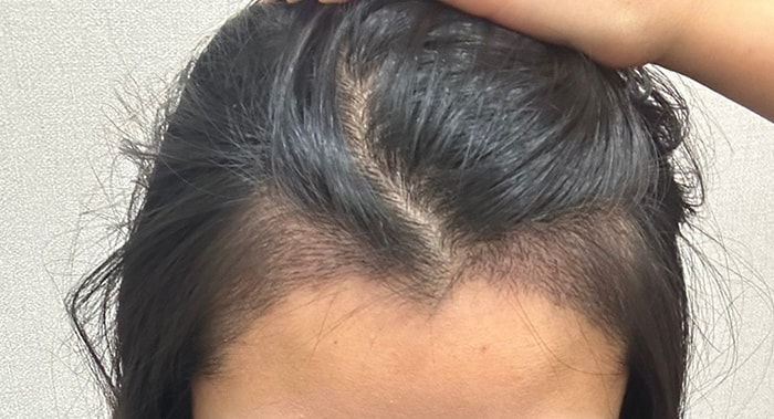 수술 14일차 셀카