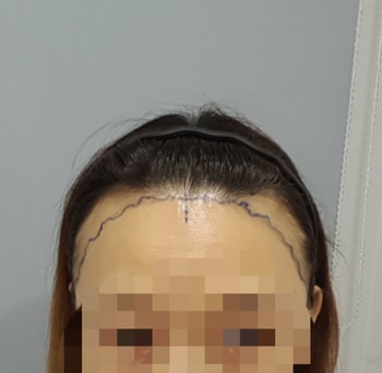 수술직전
