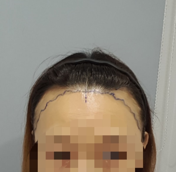 수술직전