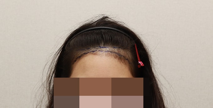 수술전