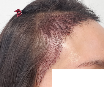 수술 3일차 첫 샴푸 모습