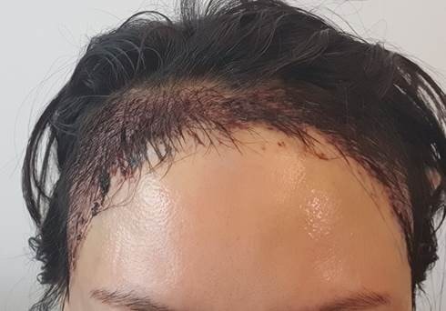 수술 직후 모습